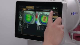 Topcon CA-800: Comparing Corneal Topography Maps Between Visits