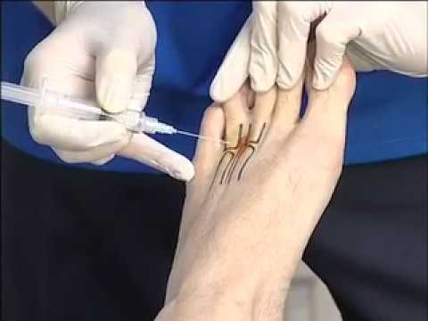 b12 injection for morton's neuroma - Everything You Need To Know Corticosteroids Mortons neuroma steroid