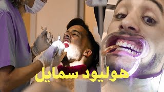 عملت تبييض الأسنان في تركيا- hollywood smile