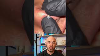 Derm reacts to juicy cyst pop on the nose! #dermreacts #doctorreacts #cystpop