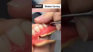 Carving Of Denture Wax Preclinical Procedure Of Denture Wax Carving