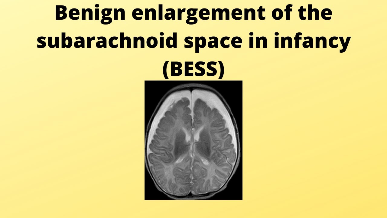 Benign enlargement of subarachnoid spaces YouTube