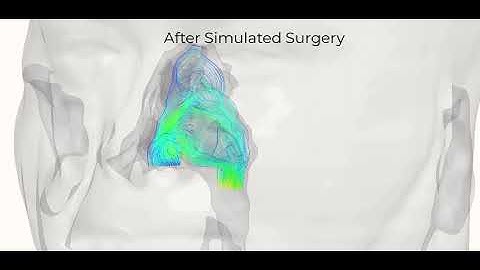 Nasal Breathing: The power of simulated surgery and CFD analysis