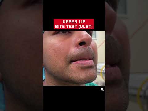 Upper Lip Bite Test (ULBT) | #shorts #anaesthetics #cico