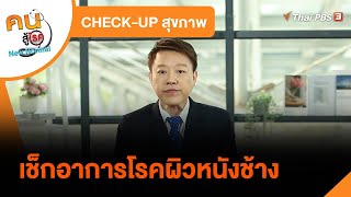 เช็กอาการโรคผิวหนังช้าง : CHECK-UP สุขภาพ