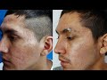 🔥 El MEJOR TRATAMIENTO para CICATRICES DE ACNE y otras 2021✅ DERMAPEN + SUBCISION / ANTES Y DESPUES