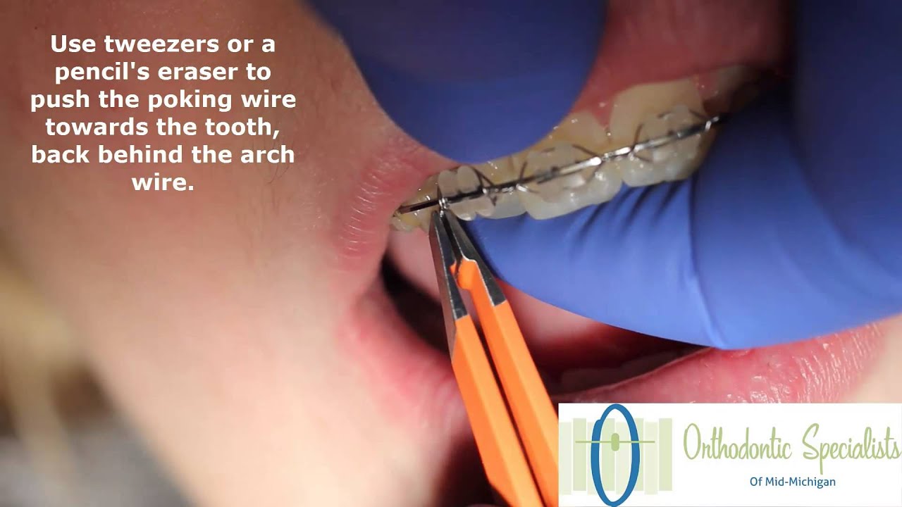 Braces Home Remedies YouTube