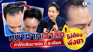 หน้าผากเว้าลึก ทำให้กลับมาแน่น ถี่ละเอียดได้ไหม? โดยไม่ต้องกินยา