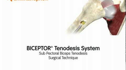 Intro Sub Pectoral Biceps Tenodesis - Simon Moyes Capital Orthopaedics