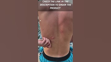 amazon must haves tiktok:Bug Bite Thing Suction Tool, Poison Remover #shorts