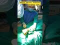 Ankle surgery #fracture#trauma#bone #patient#doctor #neetmotivation#shorts#viral
