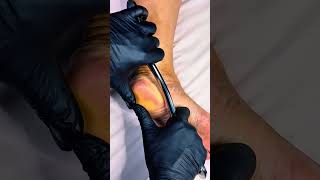 “This Ancient Scraping Technique MELTS Heel Pain and Plantar Fasciitis You’ll Feel It Instantly! “This Ancient Scraping Technique MELTS Heel Pain and Plantar Fasciitis You’ll Feel It Instantly!