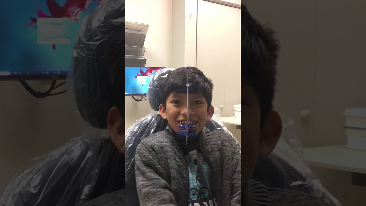 Part 1- 2 weeks after starting to wear his reverse pull headgear.