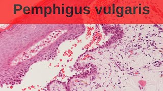 Pemphigus Vulgaris - Pathology mini tutorial screenshot 5