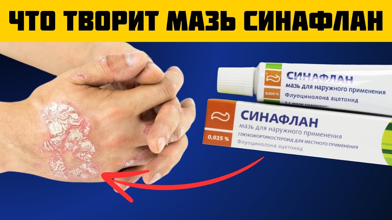 СИНАФЛАН! Вы ТОЛЬКО посмотрите на что способна эта мазь! Что Творит Синафлан?!