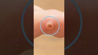 Download Lagu Foot corn or wart? #naileducation #pedicure #nails MP3 Download Lagu Foot corn or wart? #naileducation #pedicure #nails MP3