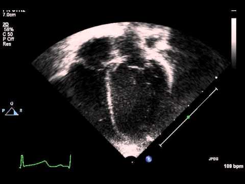 Apical 4 chamber view (2D) - YouTube