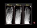 Tarsometatarsal Joints and Midfoot (Lisfranc) Sprains