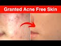 Best face pack for acne treatment naturally  home remedies for acne  how to get rid of acne