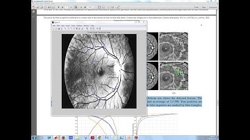 Red Lesion Detection using Dynamic Shape Features for Diabetic Retinopathy|IEEE Matlab Projects