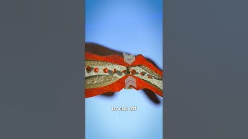 How A Ring Becomes Entrapped 💍🖐️