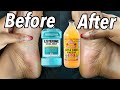 LISTERINE AND VINEGAR FOOT SOAK DOES IT REALLY WORK ?? *SHOCKING RESULTS*