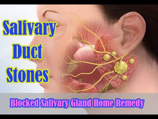 Salivary gland pop blocked Parotid Duct