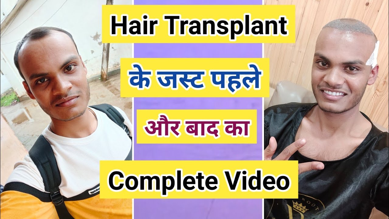 Hair Transplant Raipur City - YouTube