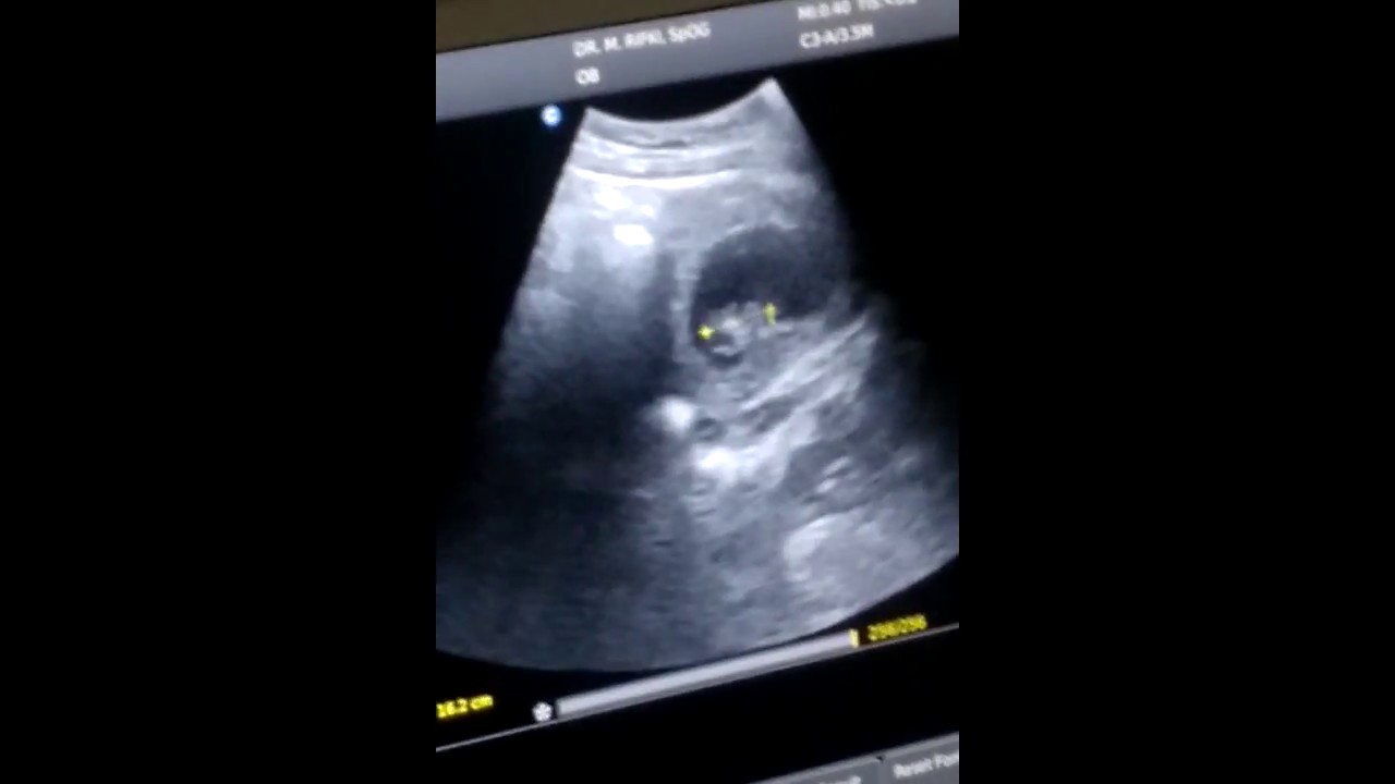  kehamilan pertama USG usia kandungan 5 Minggu YouTube