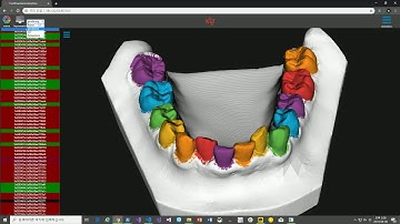 Automated teeth segmentation using Pointcloud-based Deep learning (DGCNN)