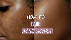 HOW TO GET RID OF ACNE SCARS ON FACE & BODY!