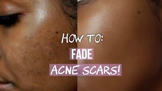 HOW TO GET RID OF ACNE SCARS ON FACE & BODY!