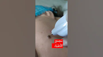 شاهد أزالة الشامات بالليزر 