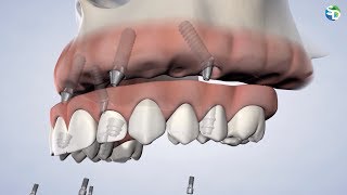 Can You Get A Full Arch of New Teeth in San Diego CA