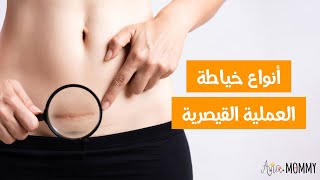 ما هي أفضل أنواع خياطة الولادة القيصرية وما هي الخياطة التجميلية