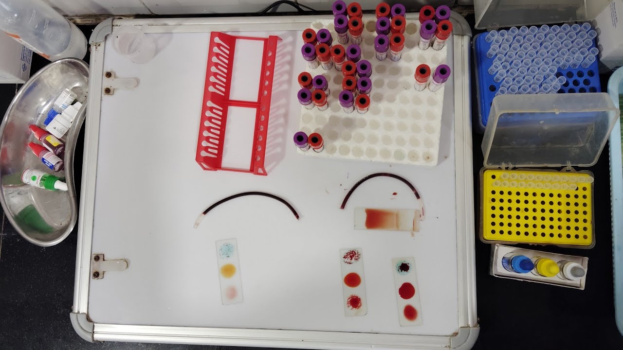 Plasma Cross Match॥ plasma का क्रॉस मैच ऐसे लगाये॥ 