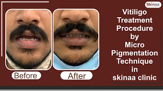 Micro Pigmentation Technique Skinaa Clinic