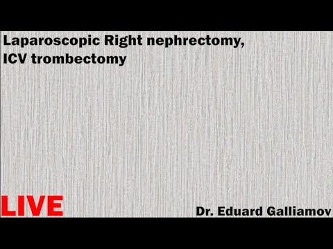 Lap.Right nephrectomy, ICV trombectomyLIVE Лапароскопическая нефрэктомия справа, тромбэктомия из НПВ