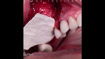 Dr. Michael A. Pikos Surgical Training Tip Abutment Fixation of Collagen Membrane over Sinus Graft