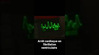 Arrêt cardique en fibrillation ventriculaire