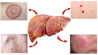 Кожные Признаки, Говорящие О Том, Что Ваша Печень В Беде