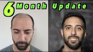 6 Month Hair Transplant Update from Turkey | 6100 GRAFTS | MORE DENSITY #hairtransplant #veraclinic