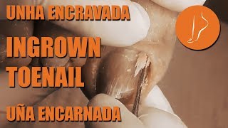 Ingrown toenail  Use of scalpel [Integral Podiatry]
