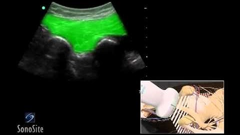 How To: Ultrasound Guided Gluteal Sciatic Nerve Block 3D Video