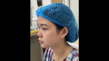 Nâng mũi Golden Line Plus an toàn, đẹp tự nhiên