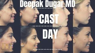 Cast Day (Rhinoplasty) at the Beverly Hills Rhinoplasty Center with Dr. Deepak Dugar
