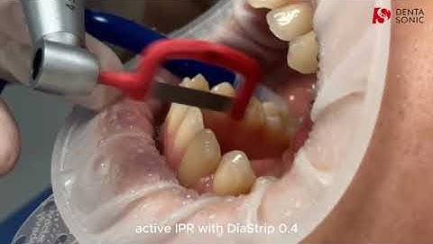 DentaSonic IPR Sequence Steps - Interproximal Reduction Strips