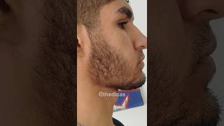 10 Meses Usando Minoxidil Antes E Depois