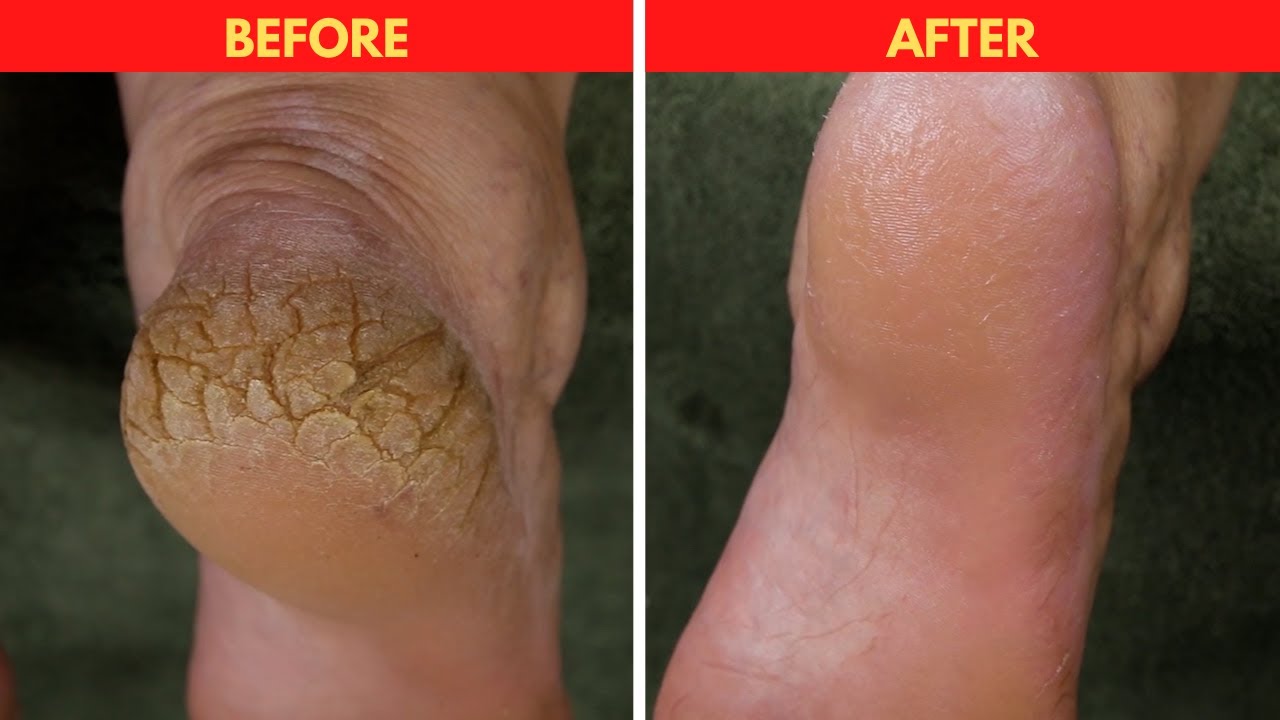 Get Rid of Your Dry Cracked Heels - How to Treat Cracked Heels Full  Treatment by miss foot fixer - YouTube