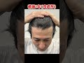 【自毛植毛】30代薄毛のメンズが別人級に生まれ変わりました!#shorts